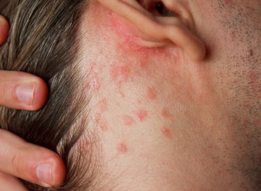 Une dermite séborrhéique sur le visage