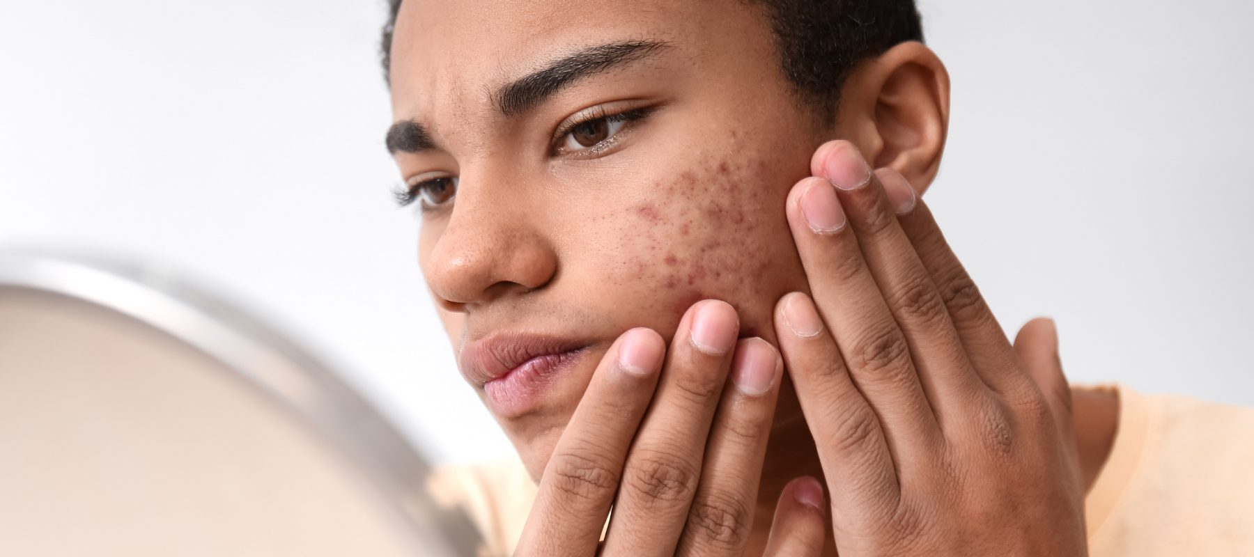 Acné adolescent