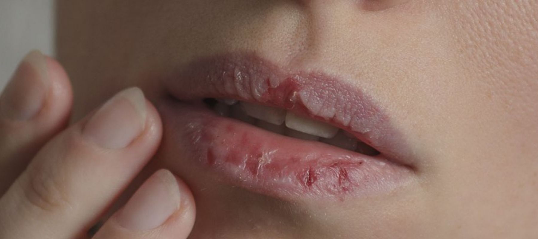 acne-dessechant