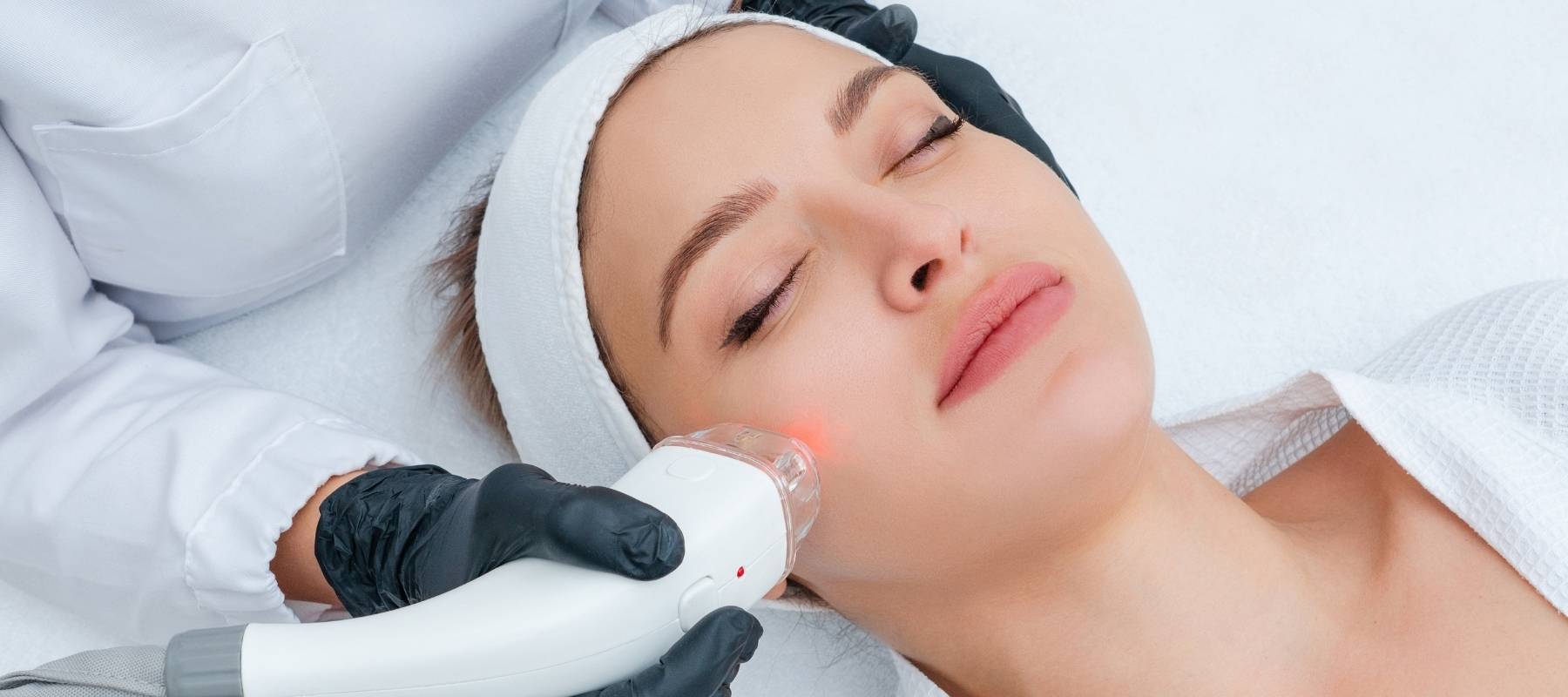acne-laser