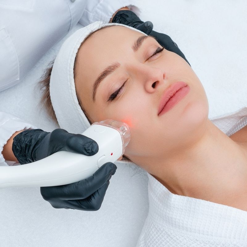 acne-laser