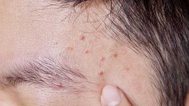 acne-tres-legere