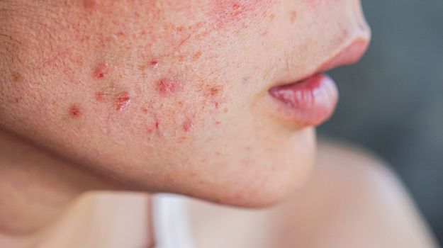 acne-moyenne-a-severe