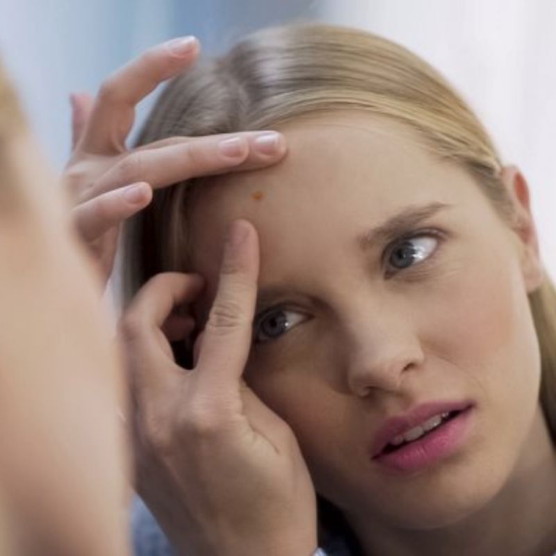 acne-retentionnelle