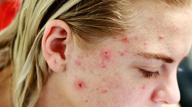 acne-tres-severe