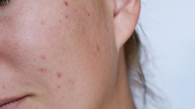 acne-legere