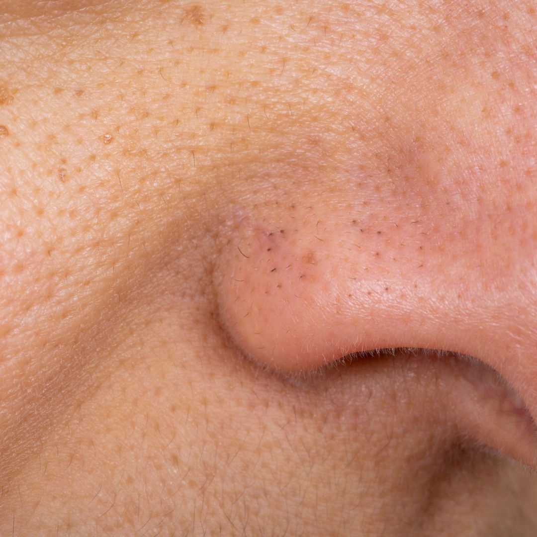 Pores dilatés