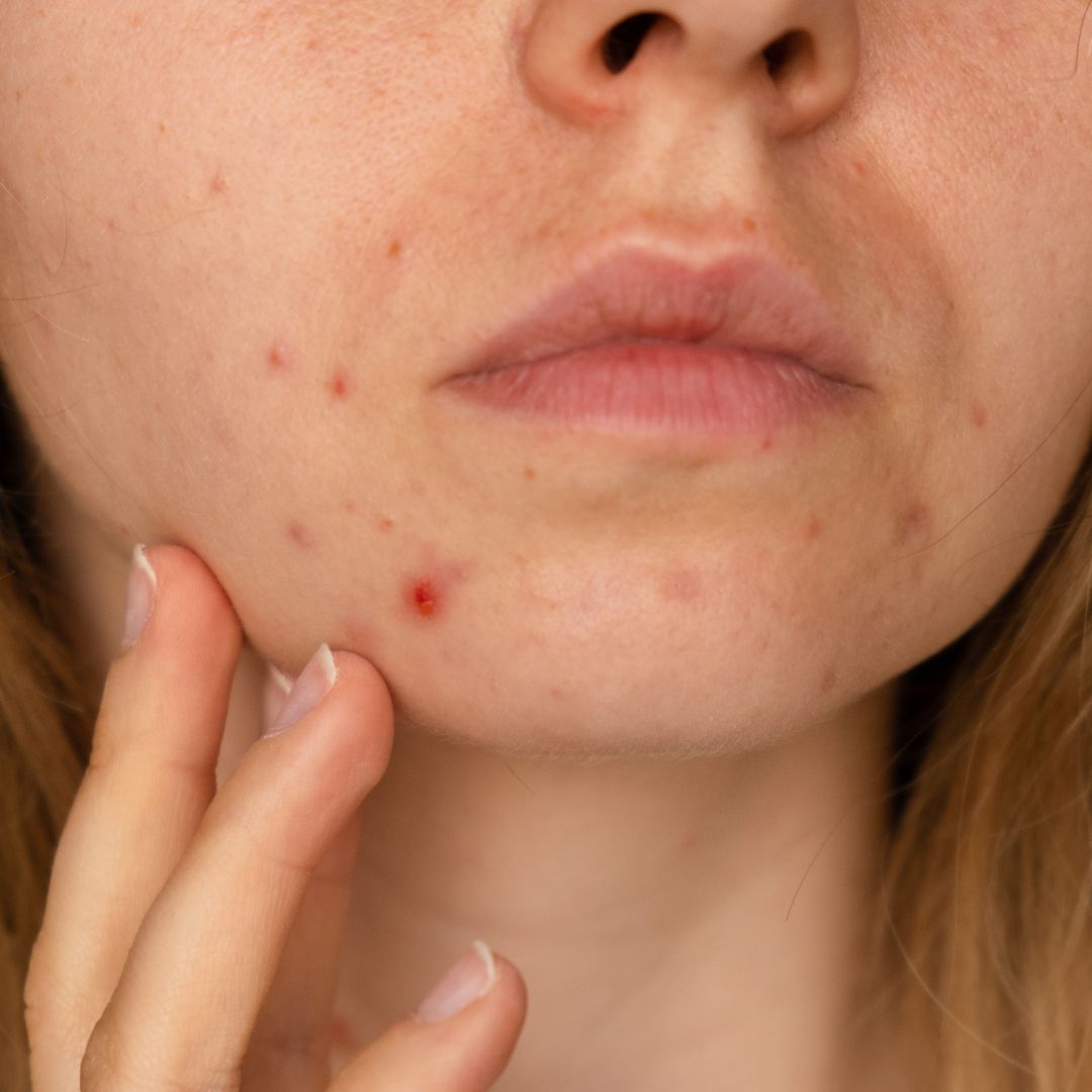 hyperpigmentation post-inflammatoire