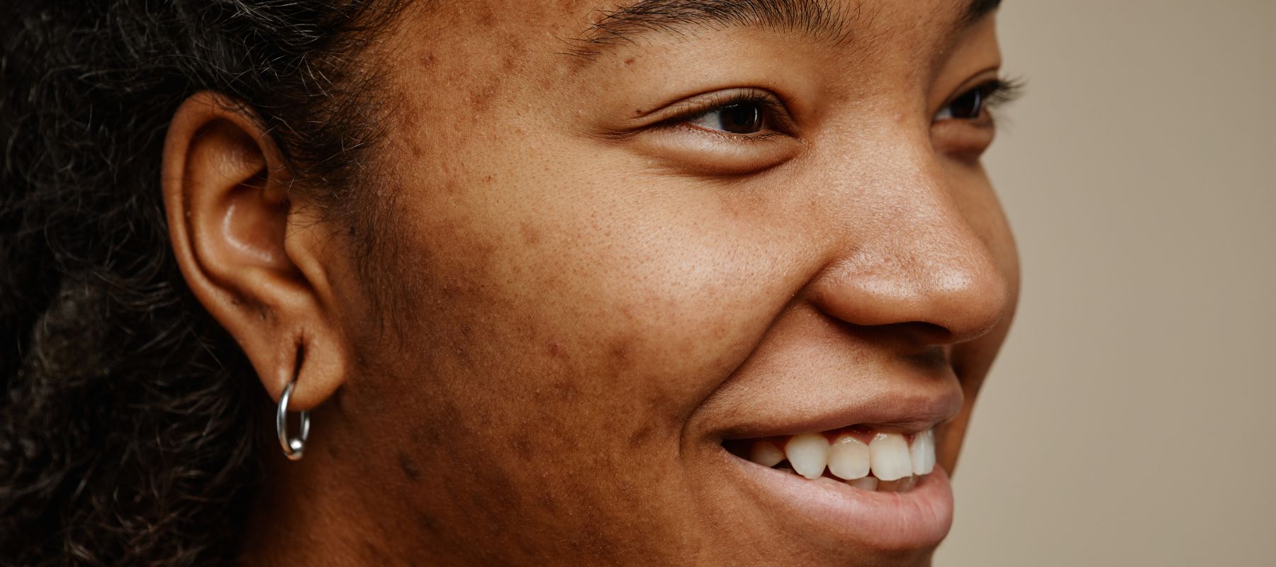 hyperpigmentation