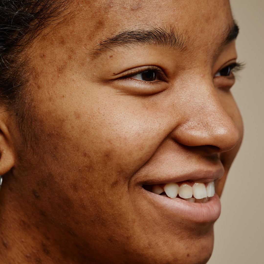 Hyperpigmentation