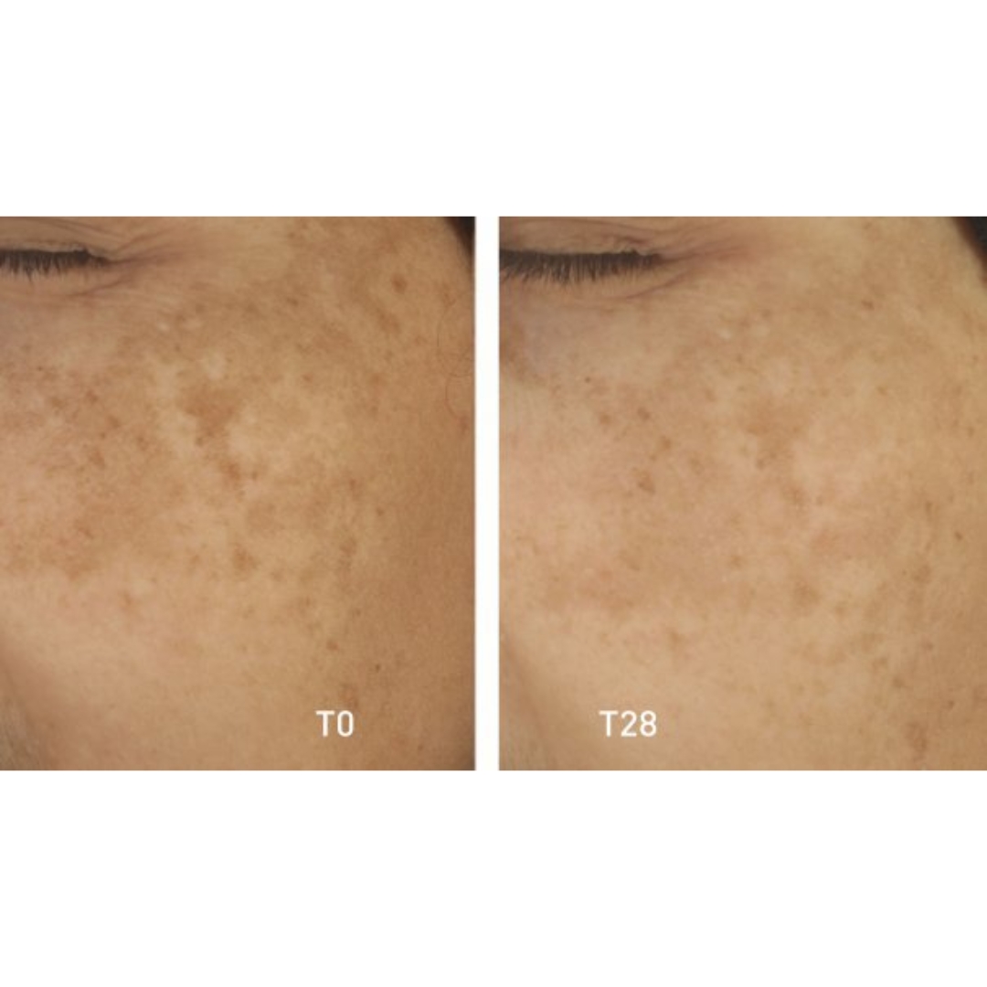 Traitements dermatologiques contre les taches pigm