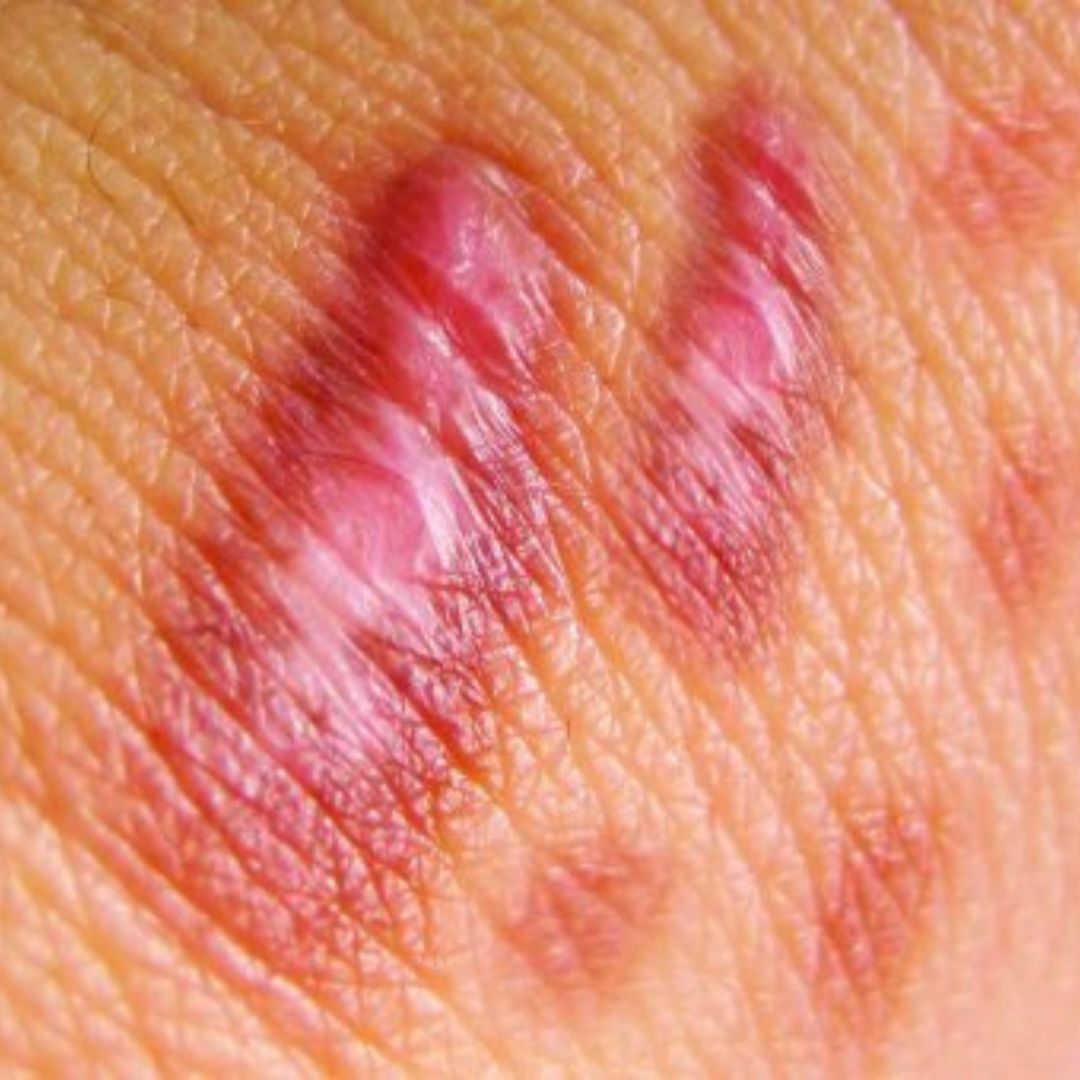 hyperpigmentation post-inflammatoire