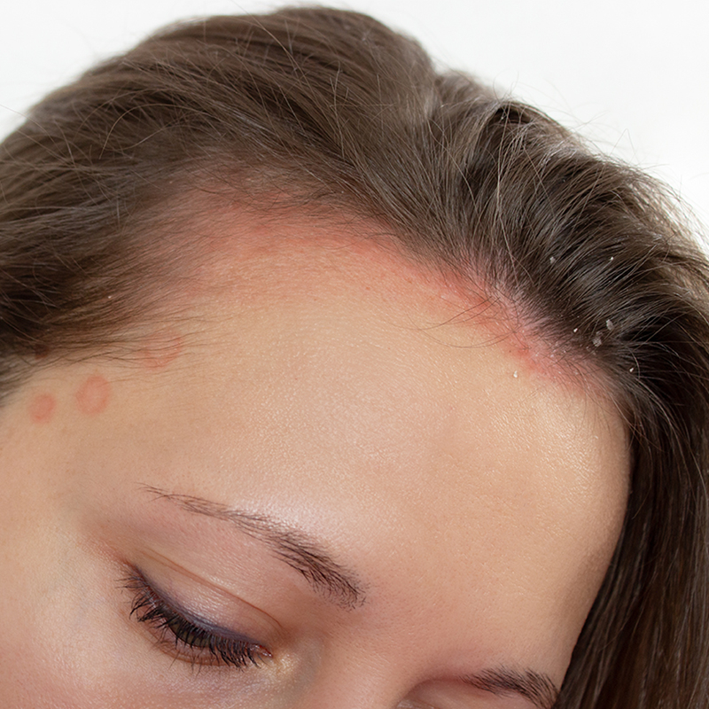 Psoriasis cheveux