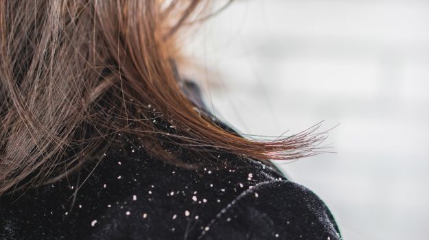 Eczéma & démangeaison du cuir chevelu