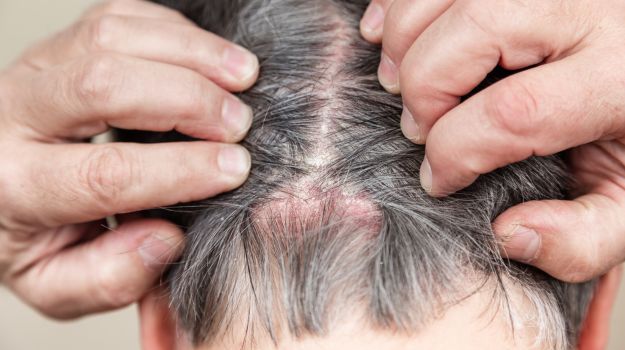 Eczéma & démangeaison du cuir chevelu