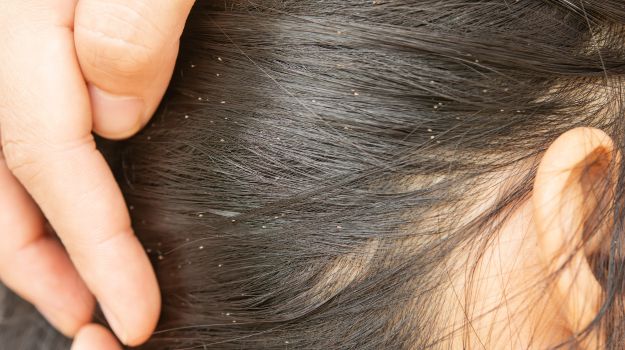 Eczéma & démangeaison du cuir chevelu