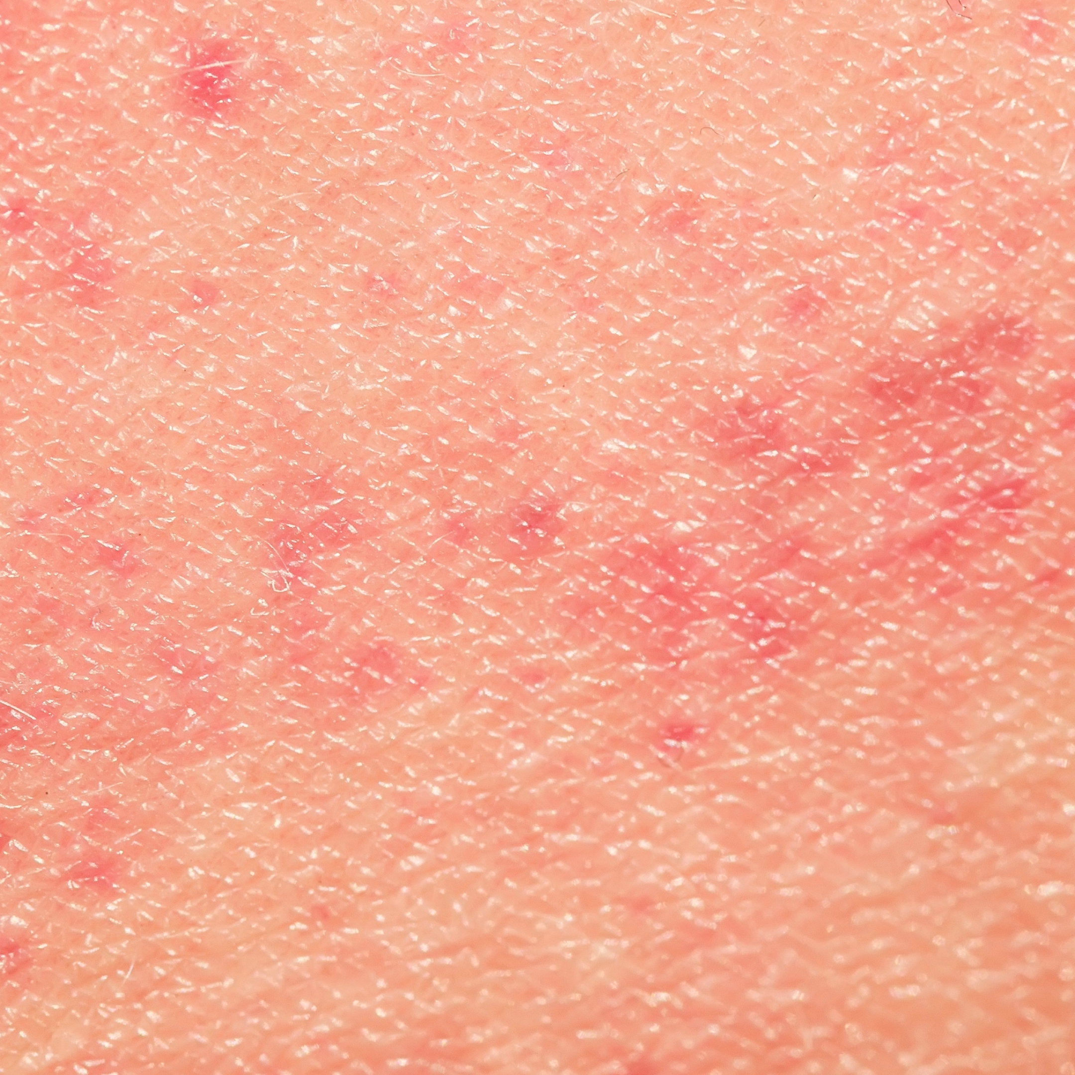 eczéma  
