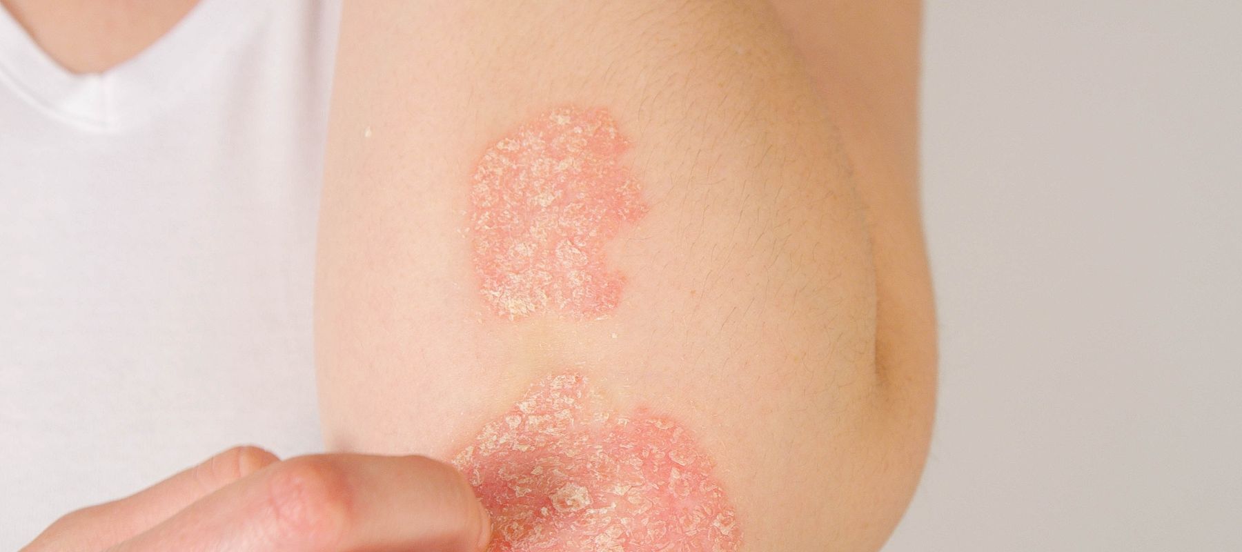 Comment reconnaître un eczéma de contact ?