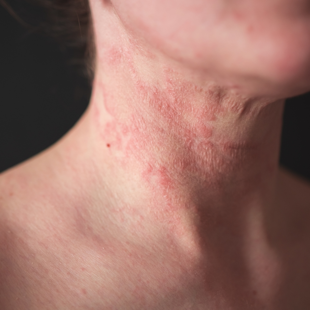 Les symptômes de l’eczéma de contact
