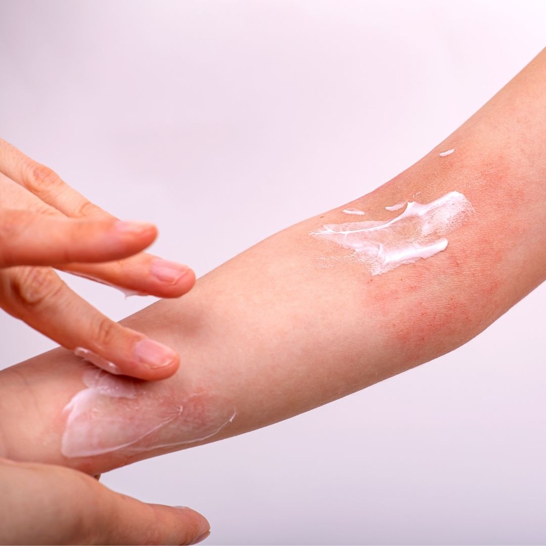 eczema dermatite atopique