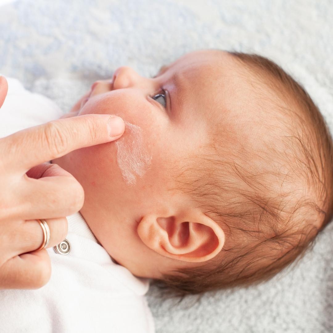 bebe et eczema