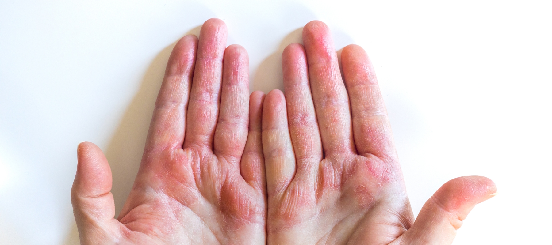 Plaques d'eczéma localisées (mains, pieds, visage.