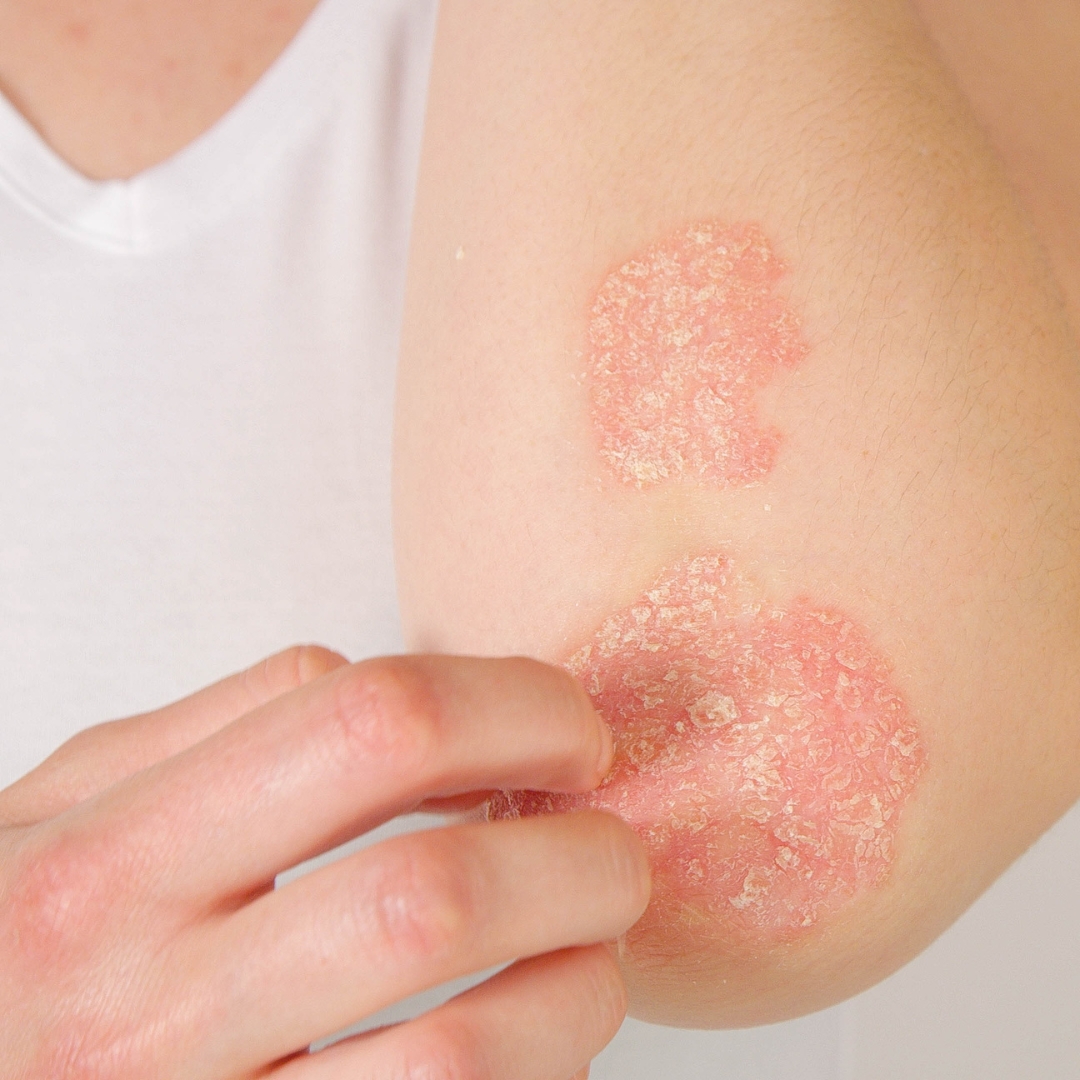 Comment reconnaître un eczéma de contact ?