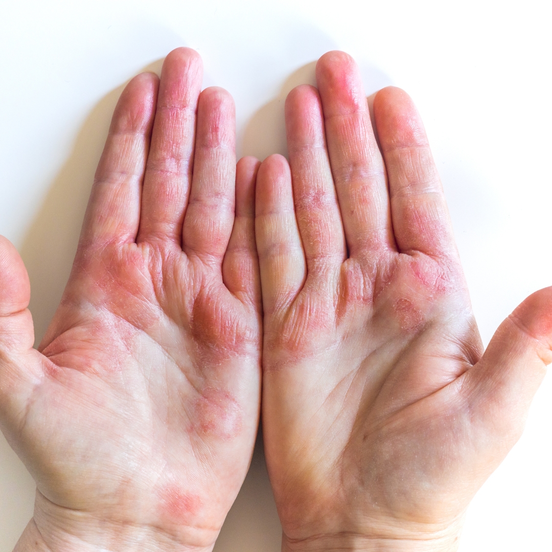 Plaques d'eczéma localisées (mains, pieds, visage...) : Quel traitement ?