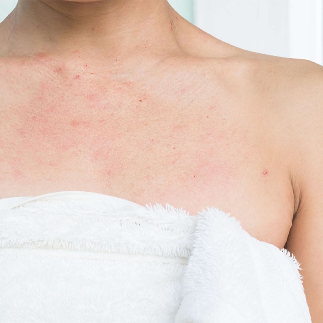 Traitement eczéma