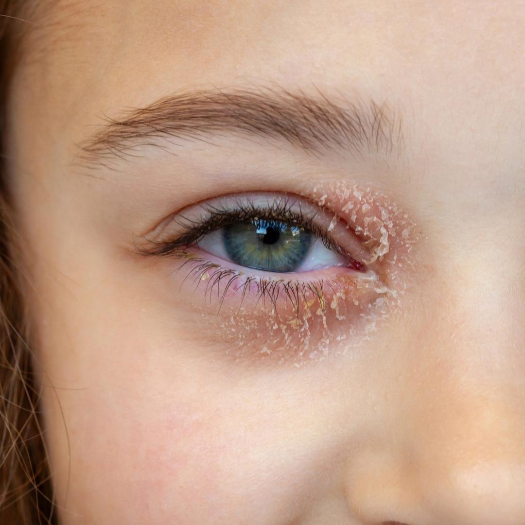 eczema paupieres symptomes