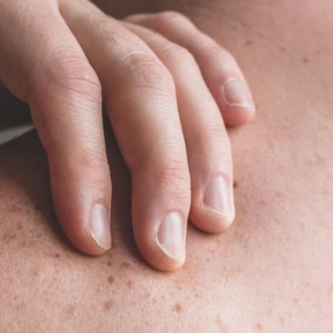 a peau fragilisée par certains traitements et maladies