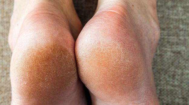 Sécheresse des pieds