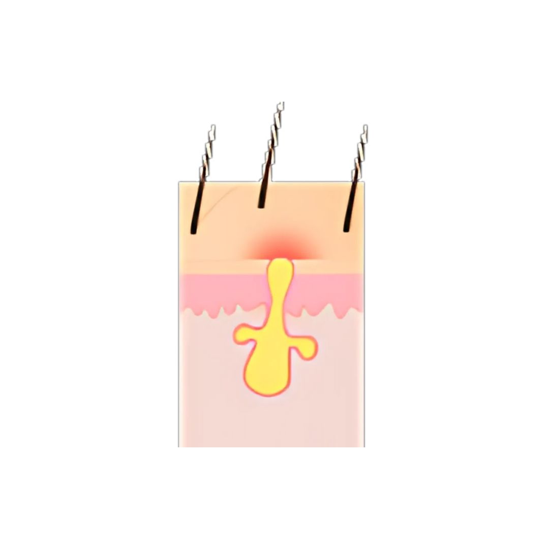 Cutibacterium