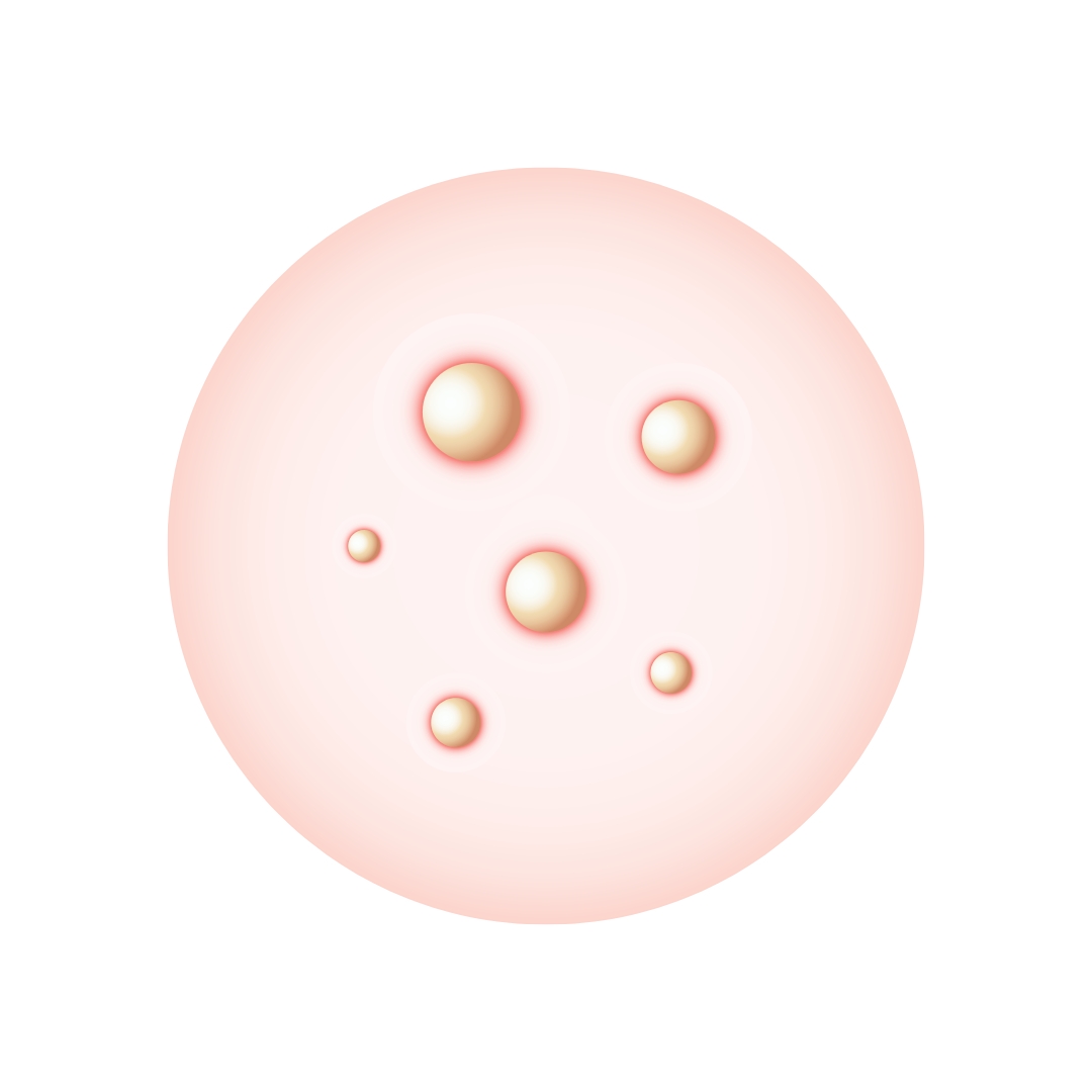 Papules