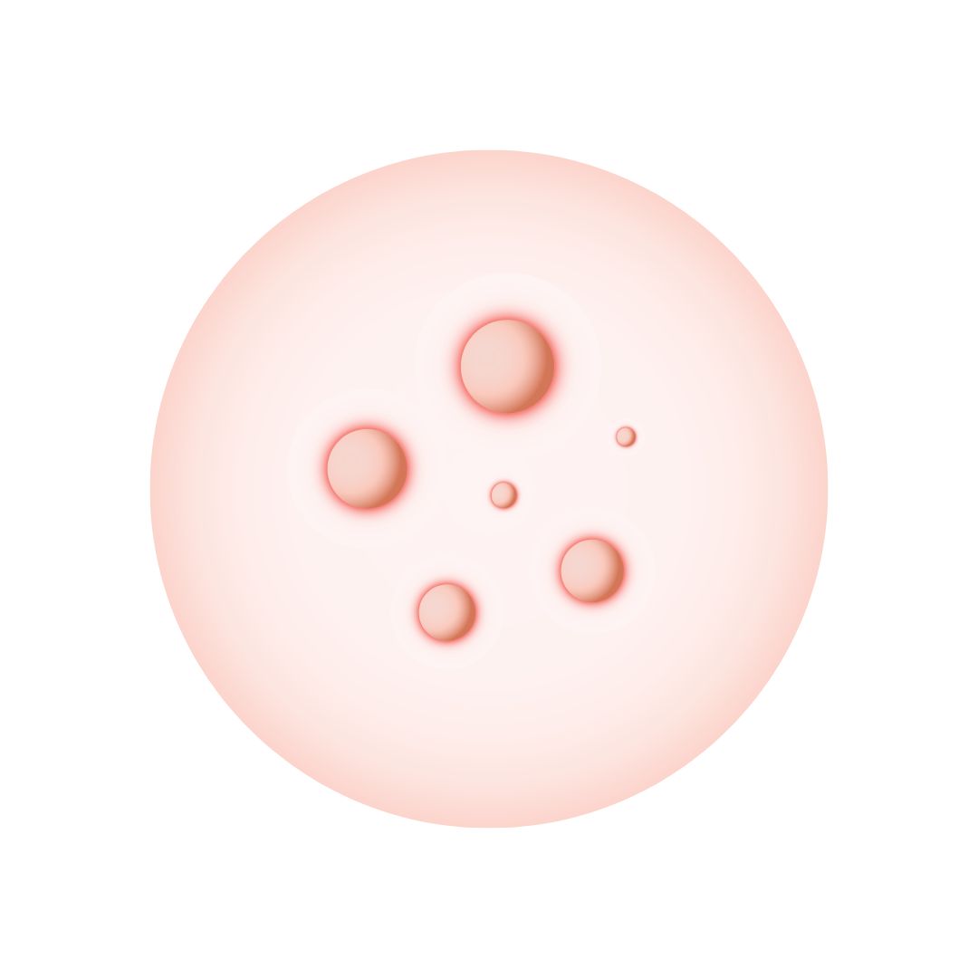 Pustules