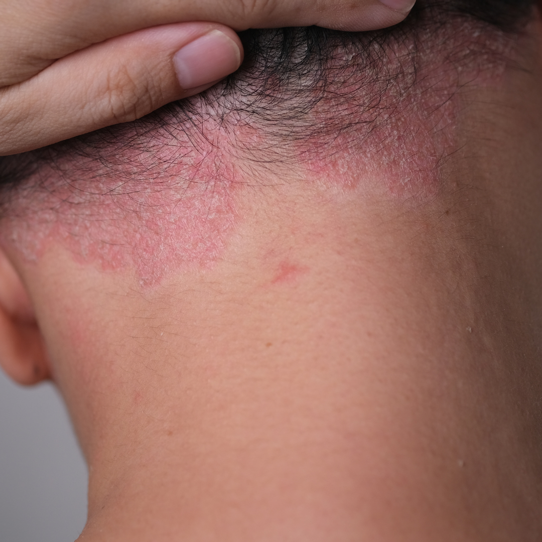 Psoriasis