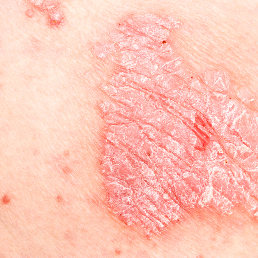 Psoriasis