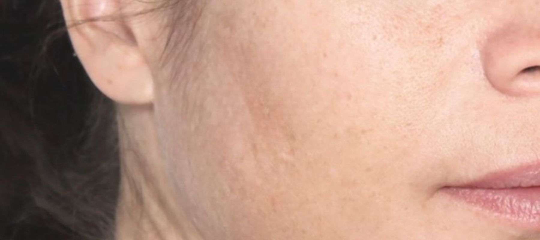 programme-dermatologique-taches