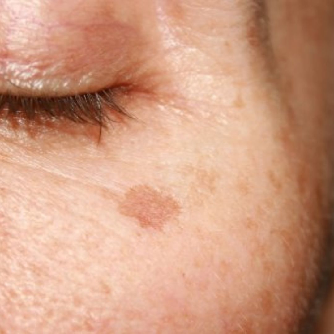T ches De Soleil Guide Complet Et Traitements Possibles BIODERMA France