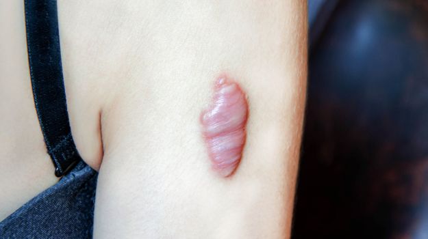 Cicatrices