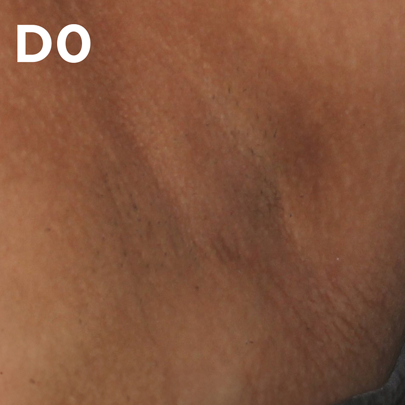 Testé cliniquement et approuvé sur les taches brunes