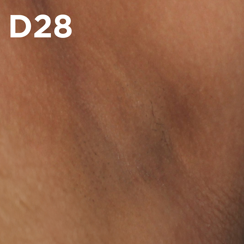 Testé cliniquement et approuvé sur les taches brunes