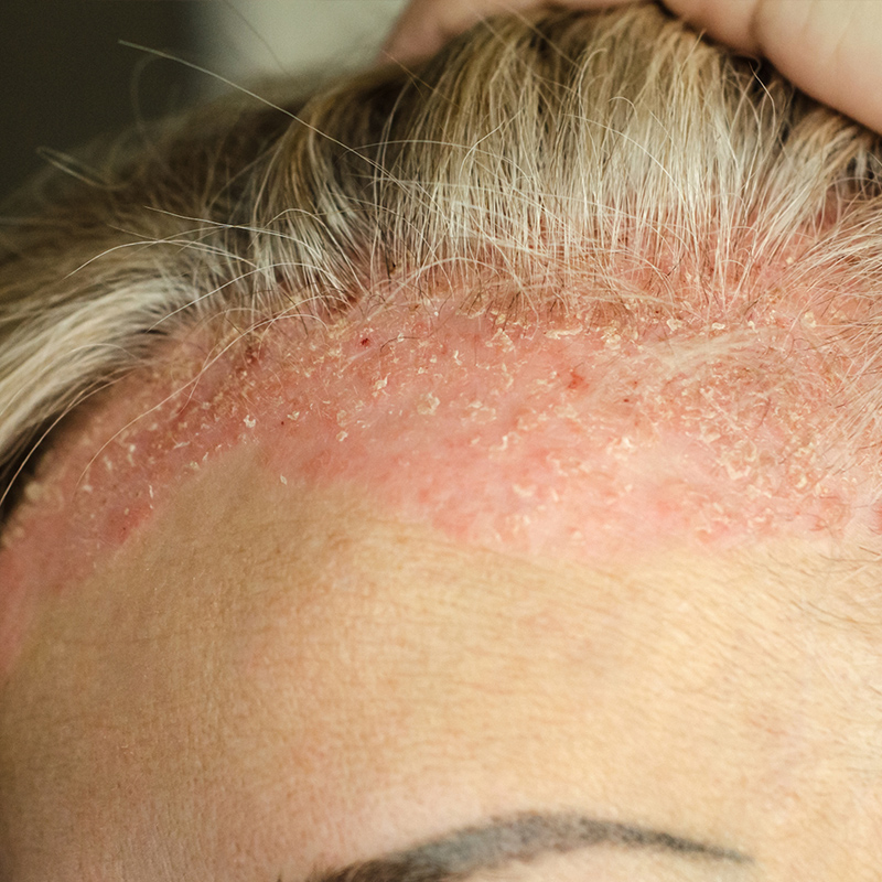 psoriasis du cuir chevelu