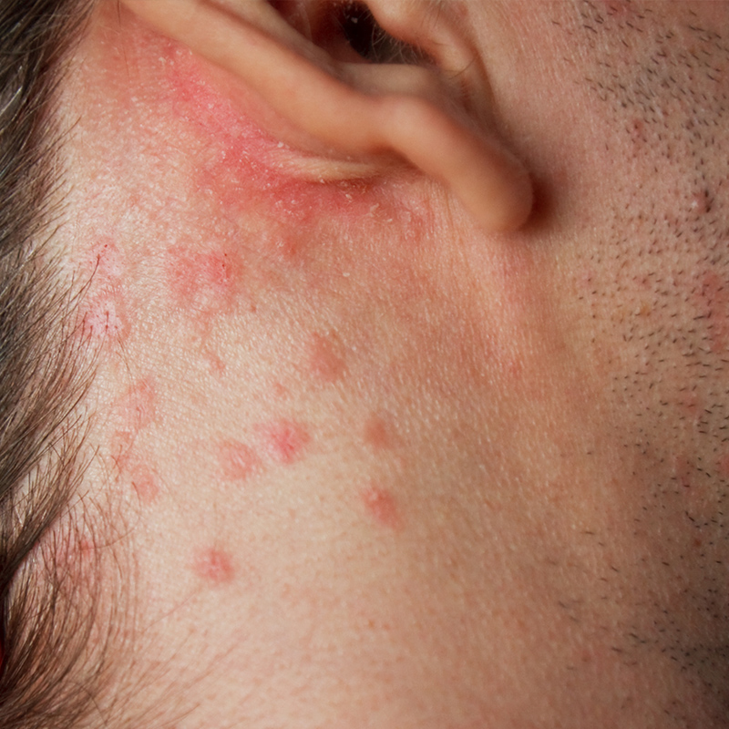 psoriasis autour de l’oreille