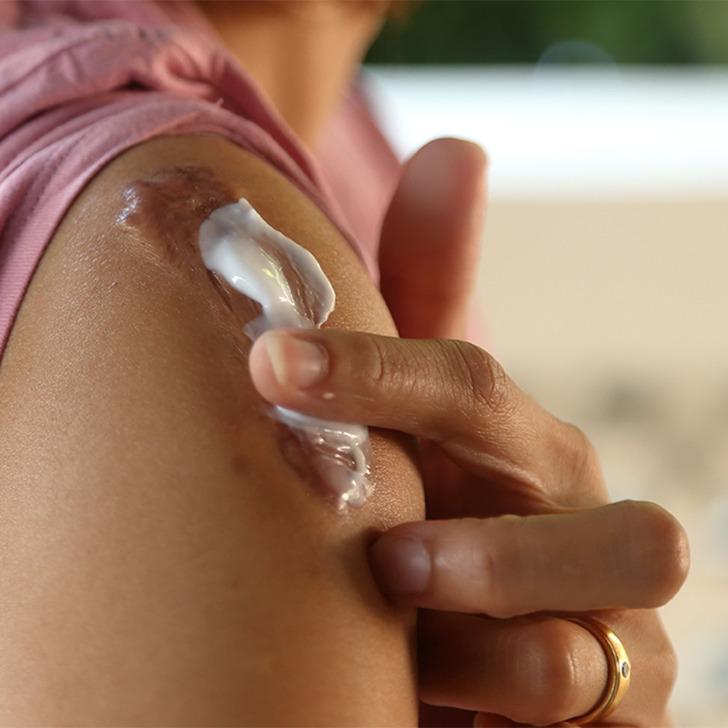 peau affaiblie et irritée appliquant de la crème sur la cicatrice