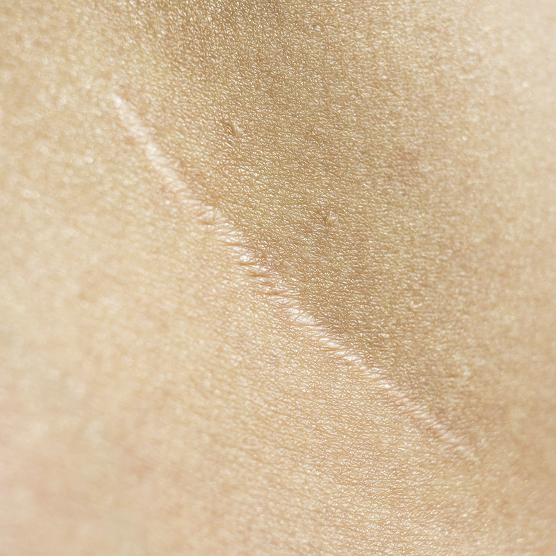 peau affaiblie et irritée gros plan de la cicatrice