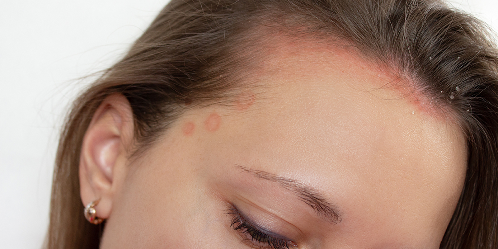 Femme atteinte de psoriasis