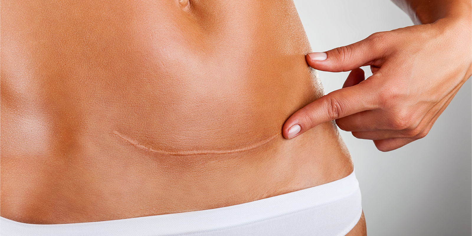 cicatrice cutanée affaiblie et irritée sur l’abdomen
