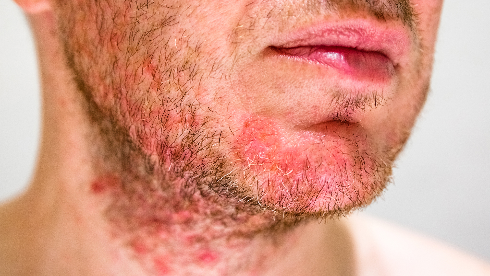 Dermite séborrhéique : Cause, symptôme, traitement | BIODERMA
