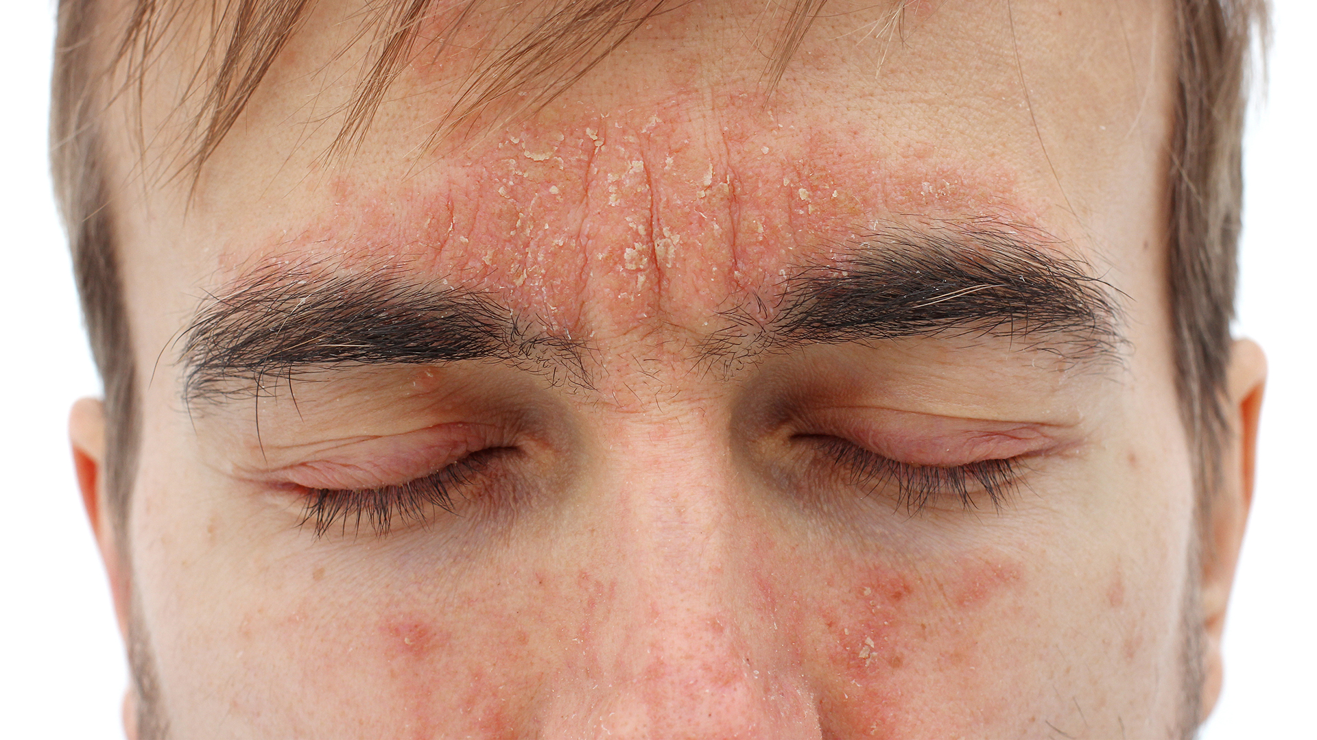 Psoriasis du visage : comment mieux vivre avec | BIODERMA
